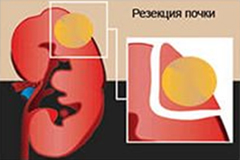 Рак почки